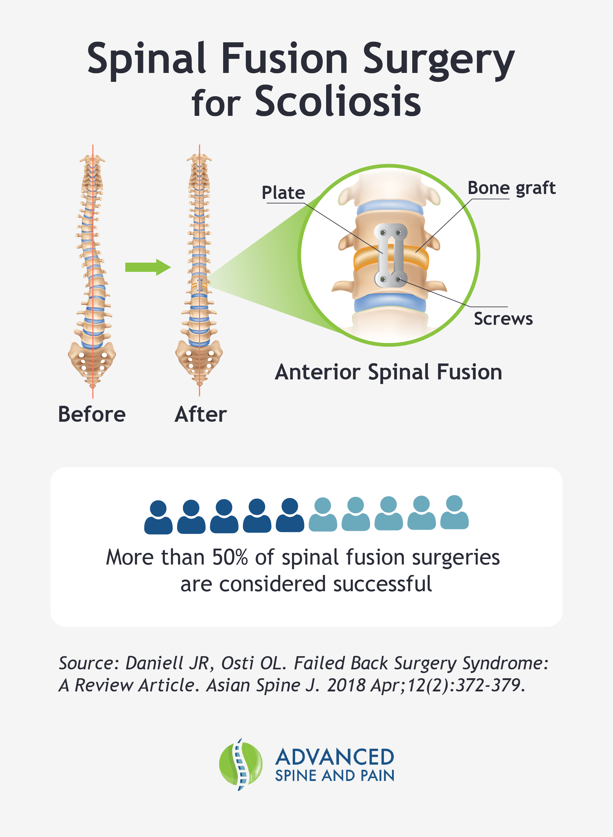 A graphic describing spinal fusion surgery.