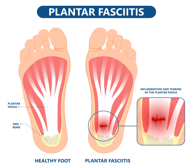 Plantar fasciitis chronic heel pain treatment Phoenix AZ