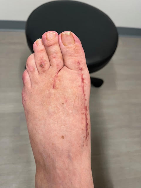 Bunion After Surgery