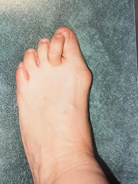 Bunion Before Surgery
