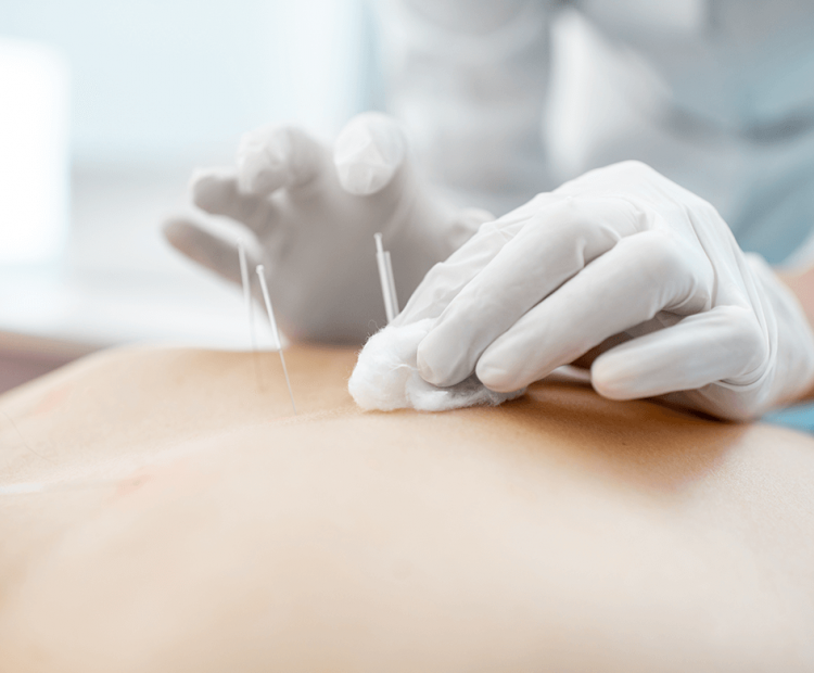 Woman receiving acupuncture treatment