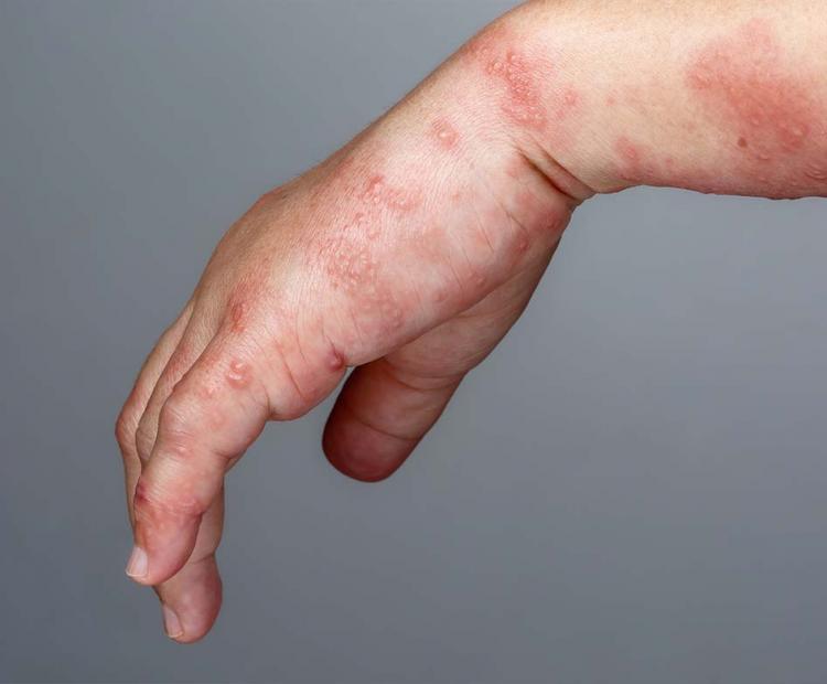 Woman's hand with shingles