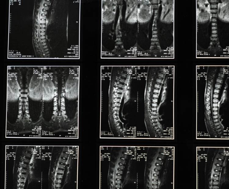 X-rays of spines used to prepare to spinal surgery.