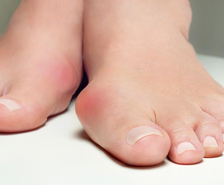 Foot and Ankle - Bunionectomy