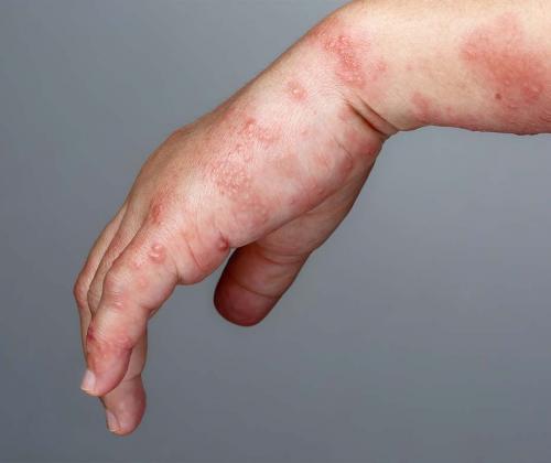 Woman's hand with shingles