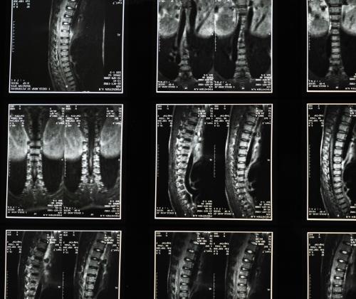 X-rays of spines used to prepare to spinal surgery.