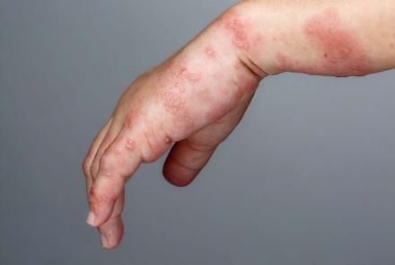 Woman's hand with shingles